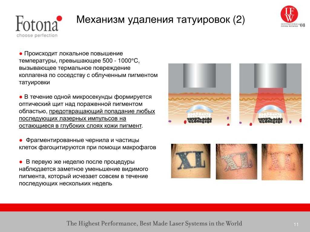 Удаление татуировки: секреты, которые скрывают от клиентов салоны красоты — центр эстетической медицины